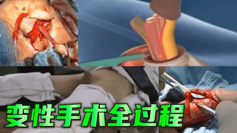 重口展示变性手术全过程