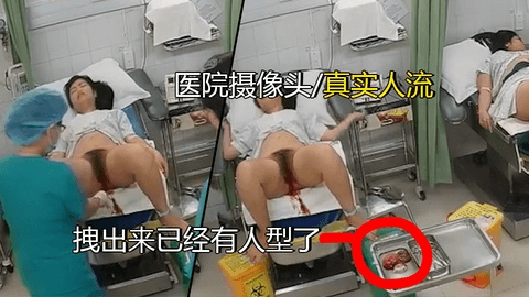 血腥！直接拽出个人型。医院监控破解偷拍来做人流的女大学生